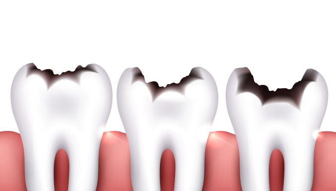 Dental caries