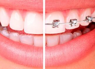 ortodoncia-y-brackets