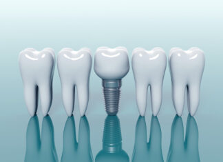 ¿El implante dental duele?